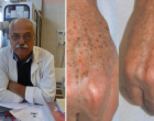 Az elismert bőrgyógyász elárulta a titkot - ÍGY szabadulhatsz meg a barna foltoktól és öregségi ráncoktól pillanatok alatt! Fillérekből elkészíthető!