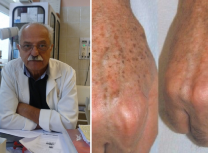 Az elismert bőrgyógyász elárulta a titkot - ÍGY szabadulhatsz meg a barna foltoktól és öregségi ráncoktól pillanatok alatt! Fillérekből elkészíthető!