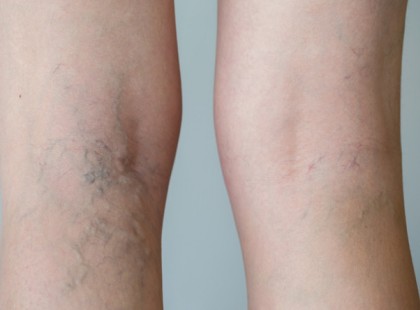 Van egy levél, ami megszabadíthat a visszerektől, a memória zavartól, sőt a fejfájástól is. Mutatjuk, mi az