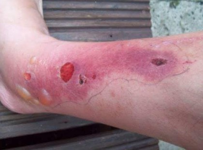 Mérgező növény terjed hazánkban,ami komoly égési sérüléseket okoz!!! Megkérlek, küldd tovább barátoknak, ismerősöknek!