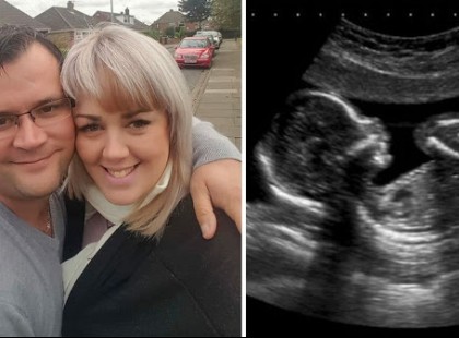 A kismama nem érezte a baba mozgását a 30.héten.Az orvosok ezt fedezték fel a méhében, szinte elájultak