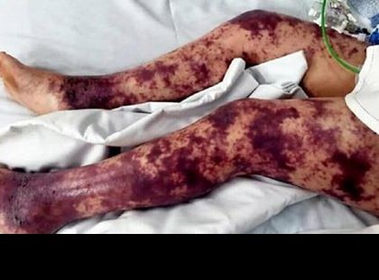 A 7 éves kislányon egyre több kék folt jelent meg – mikor édesanyja megtudta miért már túl késő volt