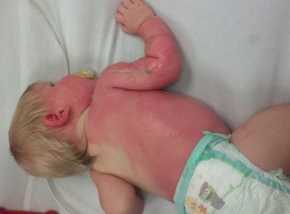 A 9 hónapos baba égési sérüléseket szenvedett a kerti slagban lévő forró víz miatt – a tűzoltók minden szülőt figyelmeztetnek