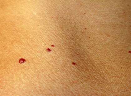 PIROS FOLTOK VANNAK A BŐRÖDÖN? EZT JELENTIK VALÓJÁBAN