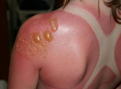 Felrobbantotta az internetet a legszokatlanabb trükk, ami megszünteti a leégést