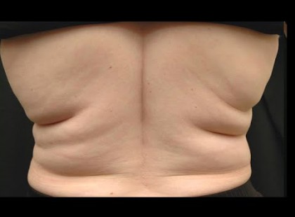 Támadd meg a hátadon a hájat! Pár nap, és el fog tűnni!