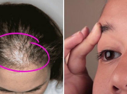 Csomókban hulló hajat visszanöveszt, sűrű lesz a szempilla és a szemöldök újra ettől