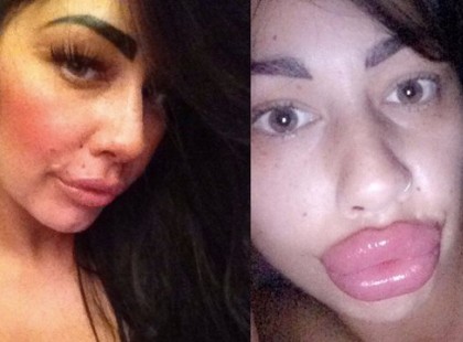 Egy perccel a szilikon injekció után holtan esett össze a nő, aki szerette volna megnövelni idomait.