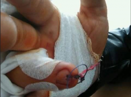 Ez már bicska nyitogató!Alkartörés után átfúrták egy nő körmét, egy gumit átfűztek rajta, amit a csuklójához rögzítettek,hogy magának tudja tornáztatni