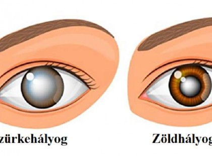 EZ A HÉTKÖZNAPI FŰSZERNÖVÉNY SZÁMOS SZEMBETEGSÉGEN SEGÍTHET!