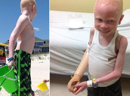 Döbbenet! Ennek az albínó kisfiúnak a karjait eladta a saját apja közel 13 millió forintért. Az indok és ami mögötte van elképzelhetetlen. Nem bírtuk ki könnyek nélkül..