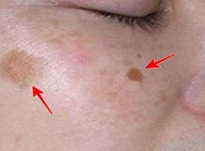 Dörzsöld ezt rá a ráncaidra, barna foltokra, sebhelyre és figyeld, ahogy elkezdenek elhalványulni. Az orvosom sem hitte el az eredményt!