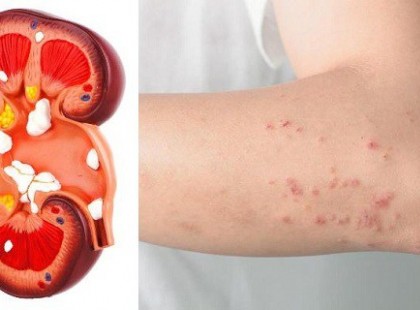 Ha a veséid bajban vannak a tested ezt a 8 jelet adja majd neked!