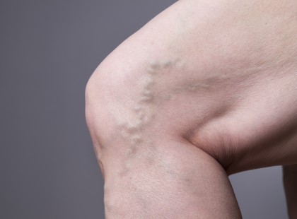 Elképesztően csúnya visszeres volt az anyukám lába. Mindig mondtuk neki, hogy keressen fel egy orvost, de nem hallgatott ránk