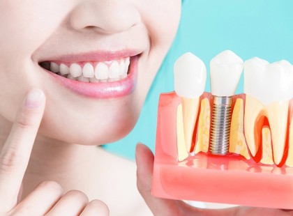 ÖN TUDTA? SOKAN NEM IS SEJTIK, PEDIG ÉLETKORTÓL FÜGGETLENÜL JÁR AZ ÁLLAMI TÁMOGATÁS FOGPÓTLÁSRA SZEPTEMBER 1-TŐL! CSUPÁN ENNYIT KELL TENNIE: OSSZÁTOK