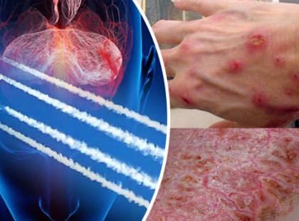 Világszerte emelkedik a chemtrail-betegek száma: a Föld globális mérgezése zajlik?