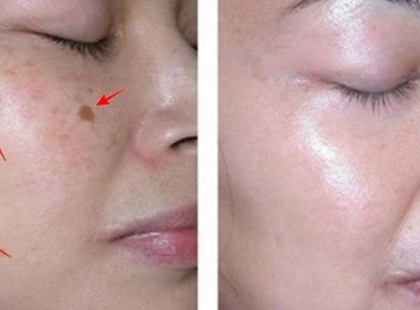 Ne hagyd, hogy ráncos vagy foltos legyen az arcod, elalvás előtt ezzel mosd át…