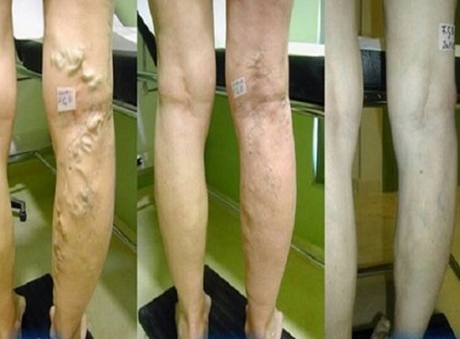 Ezzel a házi kenőccsel még a legcsúnyább visszér problémáktól is megszabadulsz!