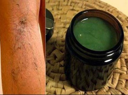 Édesanyám lábán minden visszér eltűnt napokon belül ezzel a módszerrel!