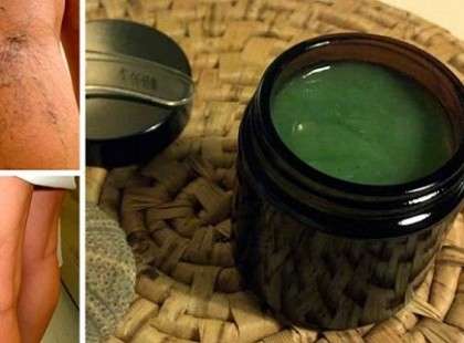 Édesanyám lábán az összes visszér eltűnt pár napon belül ezzel a módszerrel! Mi kipróbáltuk és ez tényleg működik! Ha valamit, akkor ezt igazán érdemes kipróbálni!