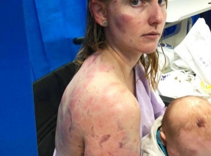 Testével védte gyermekét a jégesőtől