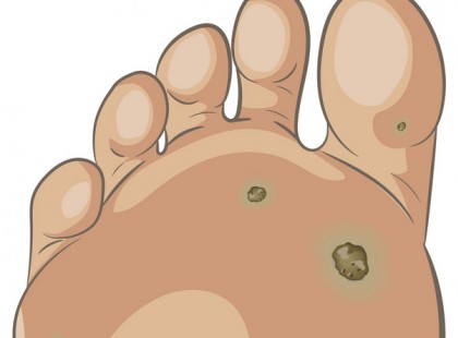 Bőrkeményedés vagy tyúkszem kínoz? Így szabadulhasz meg tőle mindörökre egy egyszerű házi módszerrel