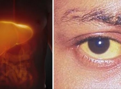 Ez öli meg a májadat, nem a szesz, mégis tömöd magadba!