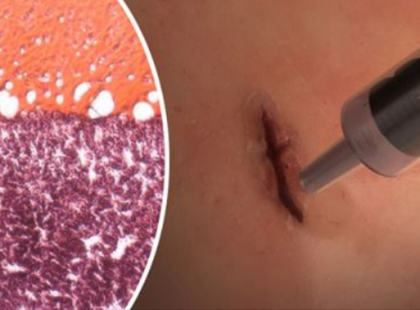 Ez a találmány ​1 perc alatt képes egy komolyabb sebet is begyógyítani. Sokan az orvostudomány legnagyobb áttöréséről beszélnek!