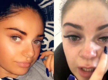 Hölgyek figyelem! Majdnem teljesen megvakult a szempilla-hosszabbítástól egy nő