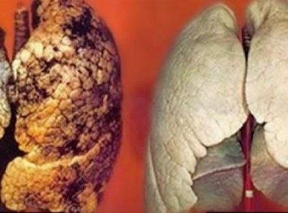 Botrány! Tüdőrákban szenvedő beteg tüdetéjét kapta meg a kórhzában a beteg. 1,5 évet élhetett csupán ezután..