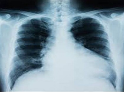 Vigyázat!!! Új tüdőbetegség pusztít a magyarok körében! Reggeli krákogással kezdődik az új halálos betegség! Veszélyesebb és alattomosabb, mint a tüdőrák!!!! Ezek a tünetek :