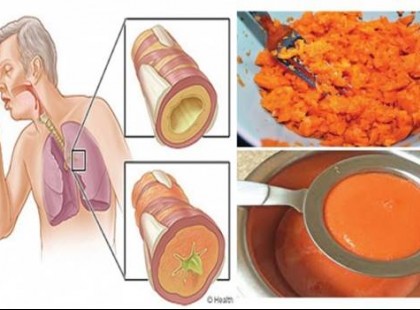 Házi köhögés elleni szirup, ami pár óra alatt eltávolítja a nyákot a tüdőből és megszünteti a gyulladást!