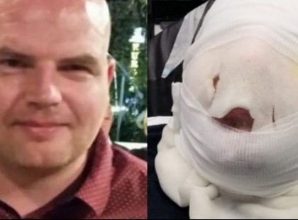 Mikróban akarta megcsinálni a tojást, majdnem egy életre megnyomorította magát