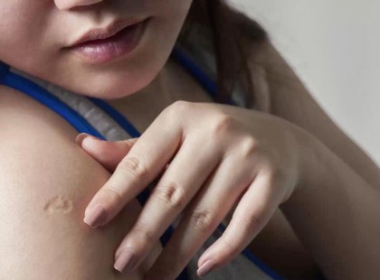 Ha 1980-an előtt születtél neked is van ilyen heg a karodon. De tudod, hogy mit jelent? Ha 1980-an előtt születtél neked is van ilyen heg a karodon. De tudod, hogy mit jelent?