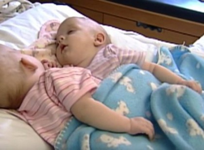 Ezeket a sziámi ikreket orvosi beavatkozással választották szét 10 évvel ezelőtt! Nézd meg, mi van velük most!