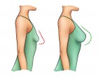 A szakemberek szerint ezért kellene minden nőnek elhagynia a melltartót