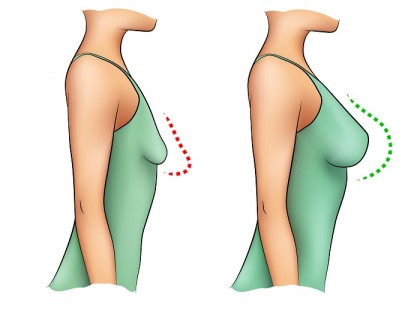 A szakemberek szerint ezért kellene minden nőnek elhagynia a melltartót