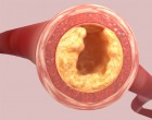 A nagy koleszterin átverés: egyes szakemberek szerint az egész csak humbuk