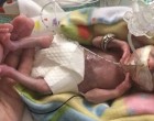 Egyik Doktor sem hitte el hogy a 21 hetes baba életben marad – nézd hogy néz ki most