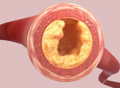 A nagy koleszterin átverés: egyes szakemberek szerint az egész csak humbuk