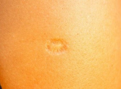 Neked is van ilyen heg a felkarodon? Tudod is, hogy mit jelent? Fontos oka van: