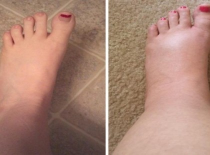 Ezzel az 5 módszerrel gyorsan kihajthatod a megrekedt vizet a testedből