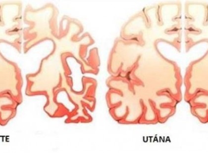 Ezt adta a férjének naponta kétszer, és megállította vele az Alzheimer kór pusztítását az agyában