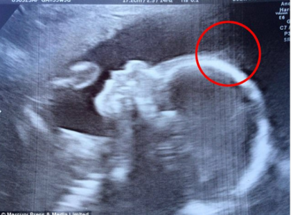 Már az ultrahangon is tisztán látszott a baba óriási haja: Így néz ki napjainkban a kicsi!