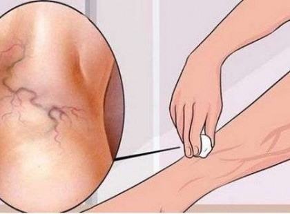 77 éves mamám ezzel az olajjal tüntette el a visszerét pár hét alatt