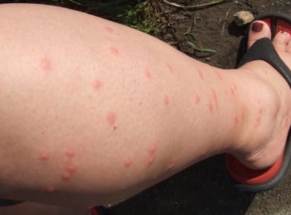 Ezért csípik meg a szúnyogok egyeseket, míg másokat nem: