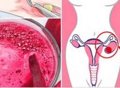 A nőgyógyász amikor cisztát vagy miómát észlel, én csak megiszom ezt és a gondom eltűnik 4 nap alatt!