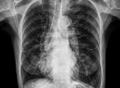 Ezt a 14 éves fiút megröntgenezték, mert azt mondta tojásokat rak. Az orvos sem hitte el, amit a képen lát
