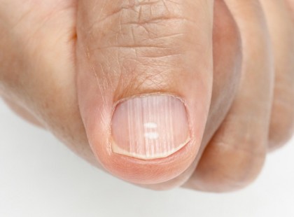 7 vitamin- és ásványi anyag hiány, ami majdnem mindenkinek van (mégsem tud róla)