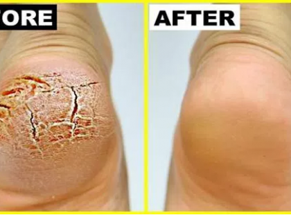 Nagyimtól tanultam ezt a trükköt, azóta nem repedezik be a sarkam